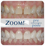 отбеливание зубов по технологии ZOOM